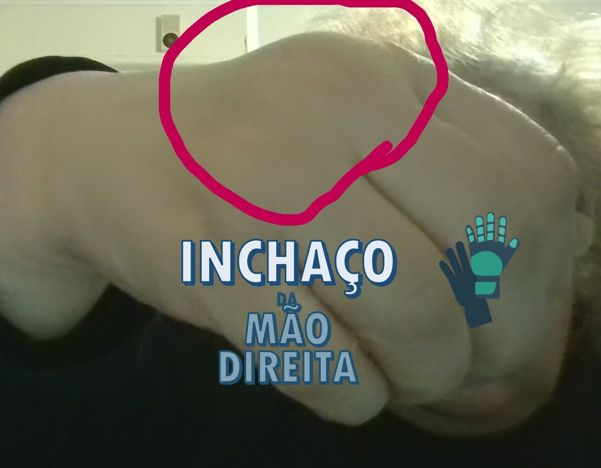 inchaço da mão direita.JPG